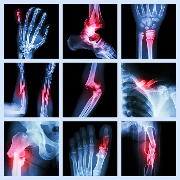 Can fractures heal without surgery