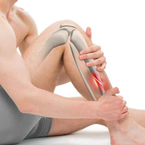 Oblique,Fracture,Of,The,Tibia,-,Leg,Hurt,Anatomy,-